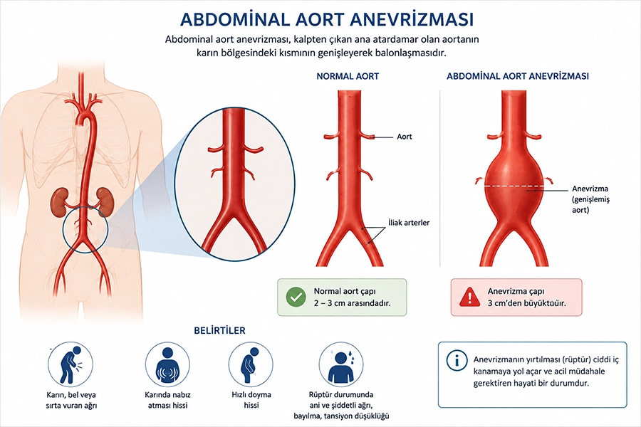 Abdominal Aort Anevrizması
